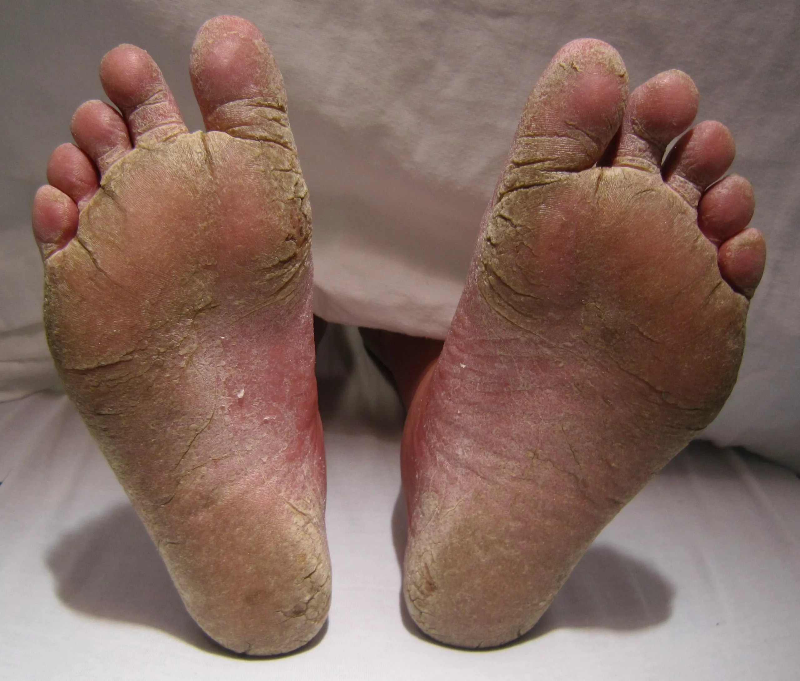 Foot Fungus Pictures: See What’s Lurking (So You Can Stop It)