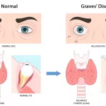 Graves Disease Life Expectancy Guide