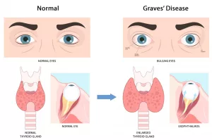 Graves Disease Life Expectancy: The Real Story on Living Well Graves Disease Life Expectancy: The Real Story on Living Well
