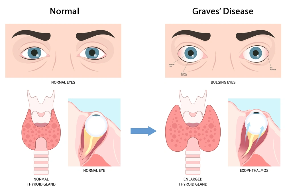 Graves Disease Life Expectancy: The Real Story on Living Well