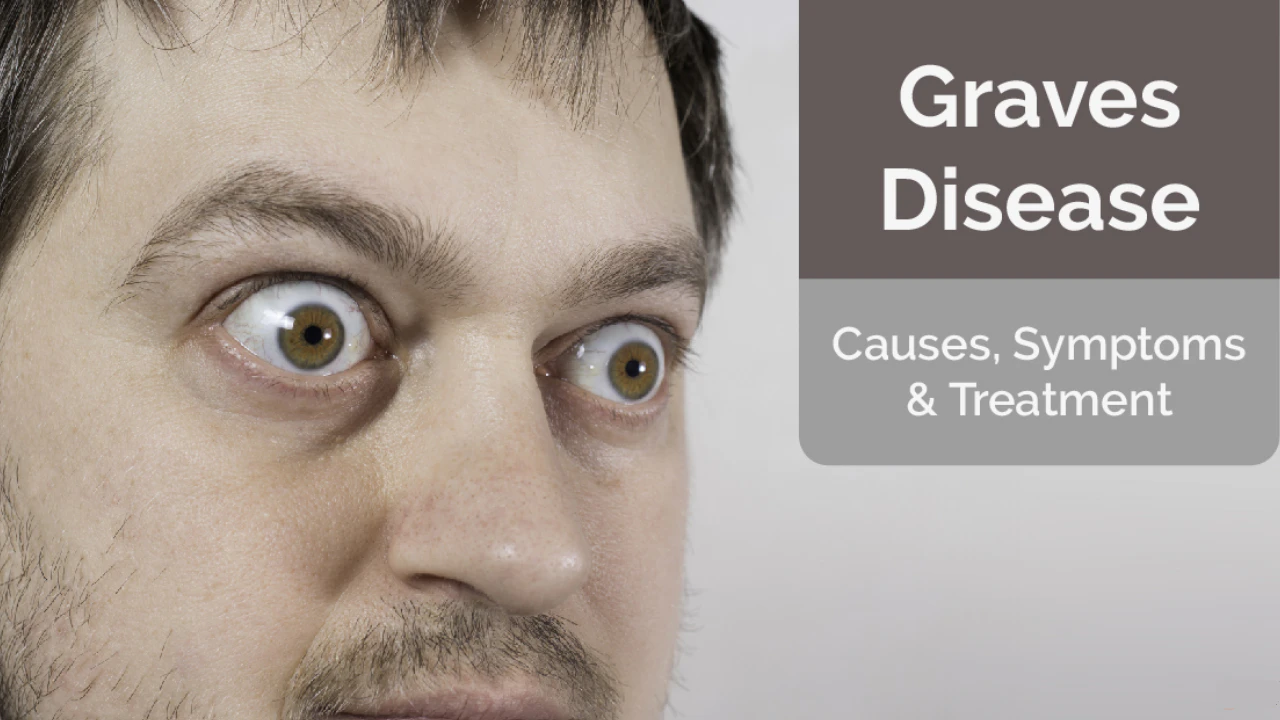 Graves’ Disease Ruined My Life: The Truth No One Tells You