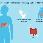 Had Gallbladder Removed Still Having Attacks? Causes
