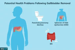 Had Gallbladder Removed Still Having Attacks? Here’s What’s Really Going On