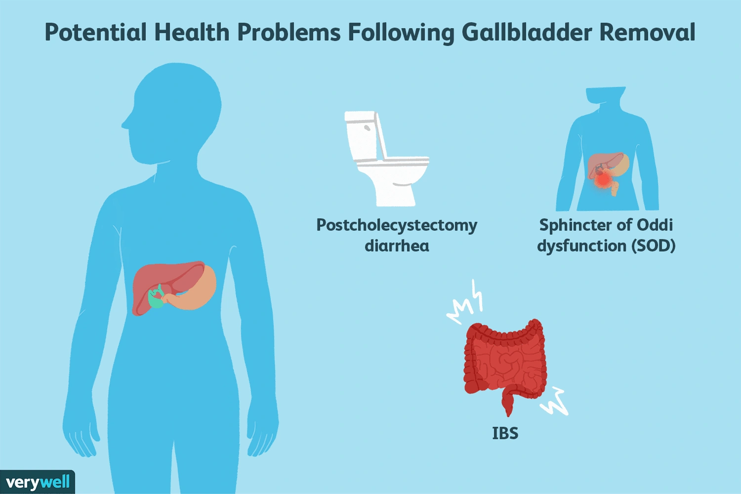 Had Gallbladder Removed Still Having Attacks? Here’s What’s Really Going On