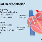 Has Anyone Died from Heart Ablation? Key Risks