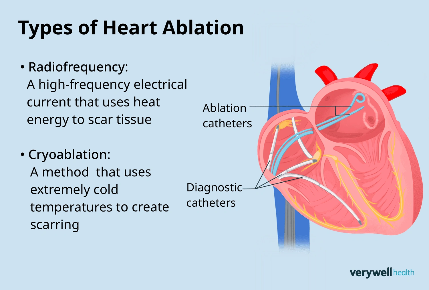 Has Anyone Died from Heart Ablation? Honest Answers and Real Stories