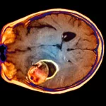 Why Head Feels Weird But Not a Headache