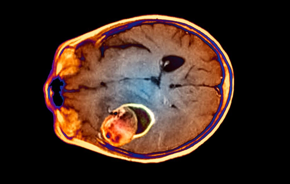 Head Feels Weird But Not a Headache: Why You Shouldn’t Ignore That “Off” Feeling