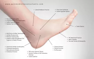 Decode Heel Pain Fast: The Heel Pain Identifier Chart You Need