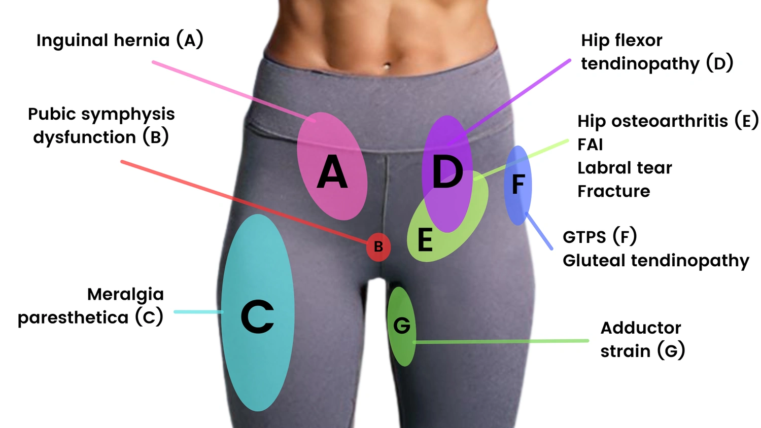 Hip Pain Location and Causes: Mapping Your Body’s Clues
