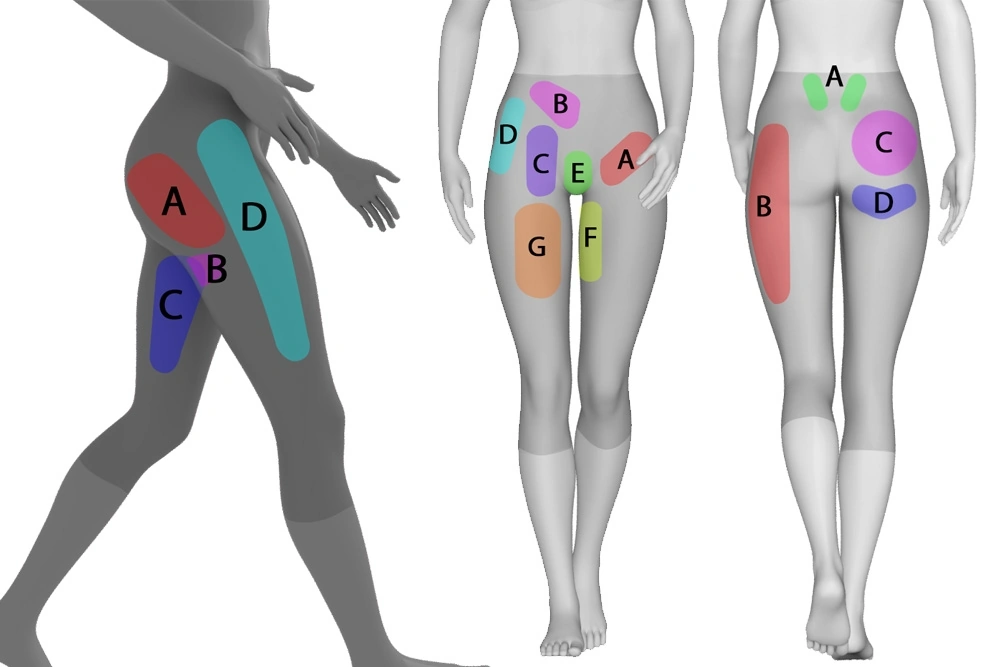 The Ultimate Hip Pain Location Chart: Find Your Relief Fast