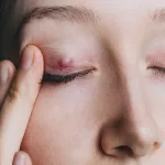 How Long for Chalaziin to Go Away Naturally?