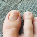 How Long for a Toenail to Grow Back?