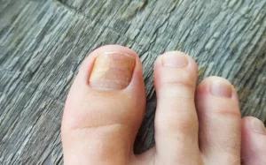 How Long for a Toenail to Grow Back: The Real, Messy Timeline (and How to Survive It)
