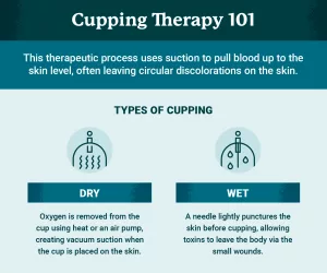 How Often Can You Get Cupping Done? (Without Going Overboard!)