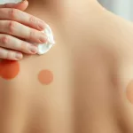 How to Get Rid of Cupping Marks Fast: Friendly, Natural Fixes That Actually Work
