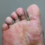 How to Identify Foot Fungus: Key Signs
