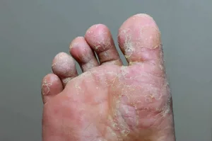 How to Identify Foot Fungus: Spot the Trouble Before It Spreads How to Identify Foot Fungus: Spot the Trouble Before It Spreads