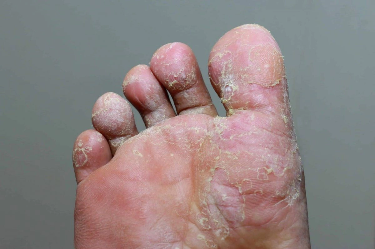 How to Identify Foot Fungus: Spot the Trouble Before It Spreads