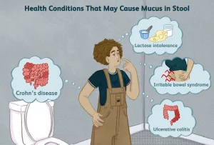 How to Treat Stool With White Mucus: Real Talk On Gut Surprises How to Treat Stool With White Mucus: Real Talk On Gut Surprises