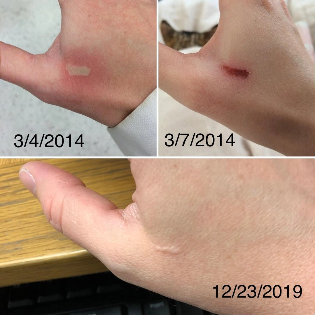 If an Acid Is Splashed on Your Skin, Wash at Once With Water