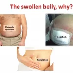 Images of Distended Abdomen: Hidden Clues