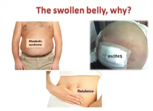 Images of Distended Abdomen: What Family Photos Might Reveal Images of Distended Abdomen: What Family Photos Might Reveal