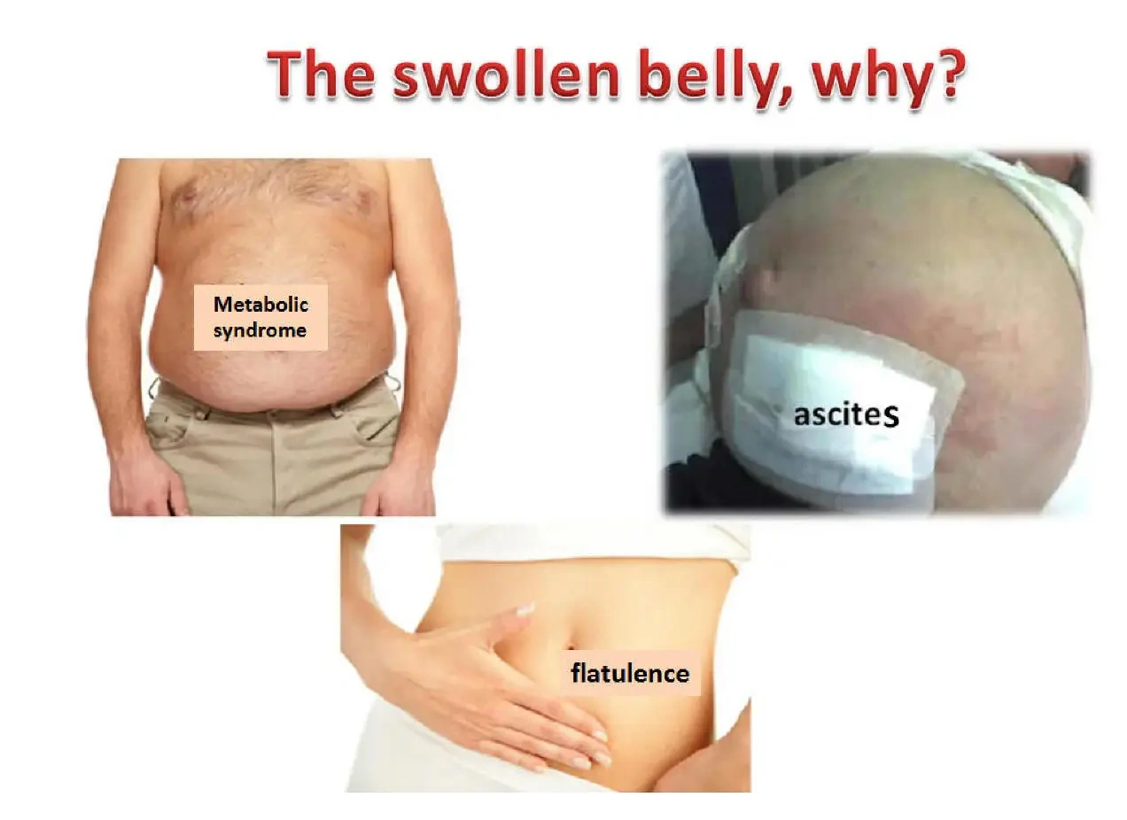 Images of Distended Abdomen: What Family Photos Might Reveal