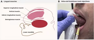 Injection Causes Spark in Tongue? Let’s Talk About That Weird Zap Injection Causes Spark in Tongue? Let’s Talk About That Weird Zap