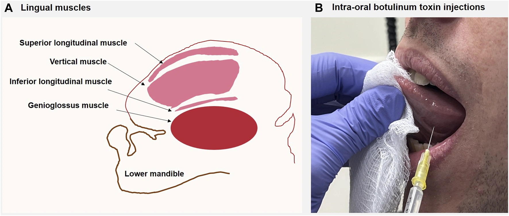 Injection Causes Spark in Tongue? Let’s Talk About That Weird Zap