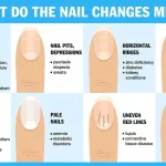 Iron Deficiency Nail Health Chart: Spot the Signs, Save Your Energy Iron Deficiency Nail Health Chart: Spot the Signs, Save Your Energy