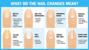 Iron Deficiency Nail Health Chart: Spot the Signs, Save Your Energy
