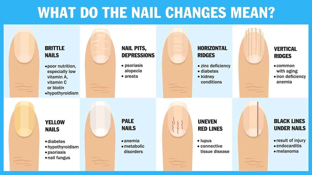 Iron Deficiency Nail Health Chart: Spot the Signs, Save Your Energy