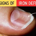 Iron Deficiency Nails Pictures: What Your Nails Might Be Telling You Iron Deficiency Nails Pictures: What Your Nails Might Be Telling You