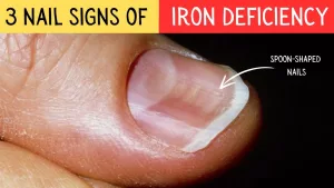 Iron Deficiency Nails Pictures: What Your Nails Might Be Telling You