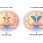 Is Huntington's Disease Fatal? Key Facts