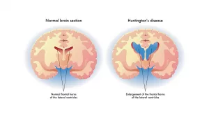 Is Huntington’s Disease Fatal? Honest Truth, Hope, and Real Talk