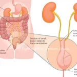 Life Expectancy After Bladder Removal