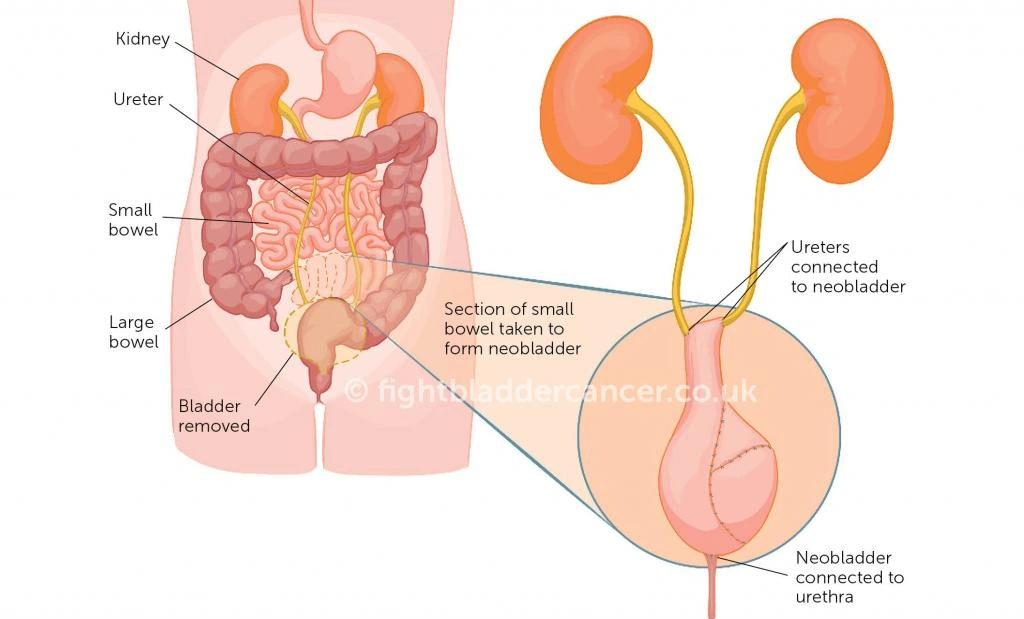Life Expectancy After Bladder Removal: What Really Shapes Your Future?