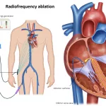 Life Expectancy After Cardiac Ablation SVT