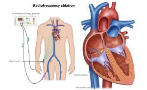 Life Expectancy After Cardiac Ablation SVT: What Really Happens Next?
