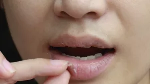 Lip Irritation from Spicy Food: Why Your Favorite Heat Hurts (and What to Do About It)