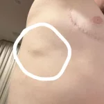 Lump Under Skin on Rib Cage Armpit for 17 Years