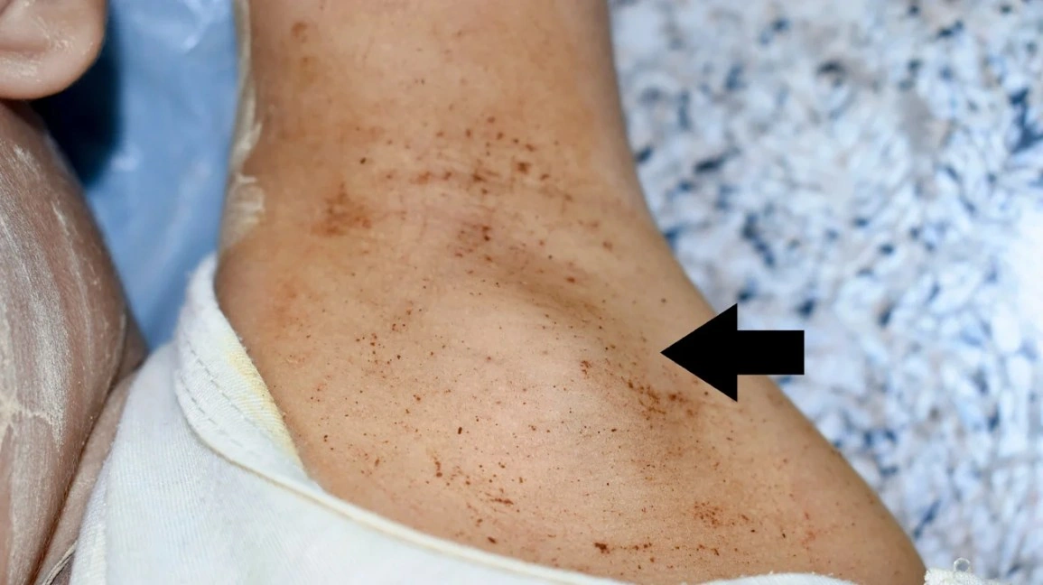 Lymph Nodes in Armpit: What That Lump Really Means
