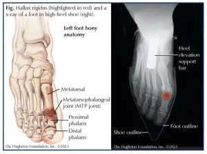 All About the Metatarsophalangeal Joint: When Your Big Toe Won’t Budge