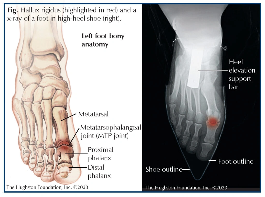 All About the Metatarsophalangeal Joint: When Your Big Toe Won’t Budge