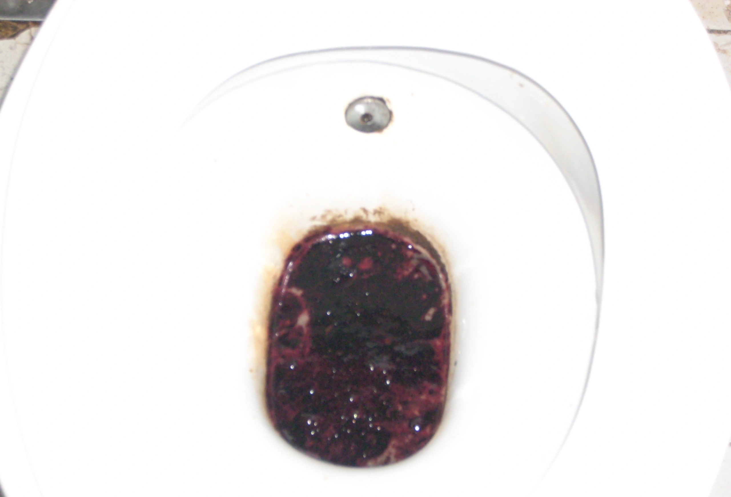 Melena Stool Pictures: What That Black Poop Really Means