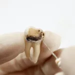 My Dentist Hit a Nerve: How Long to Get Better?