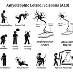 My First ALS Symptoms: Early Clues I Missed