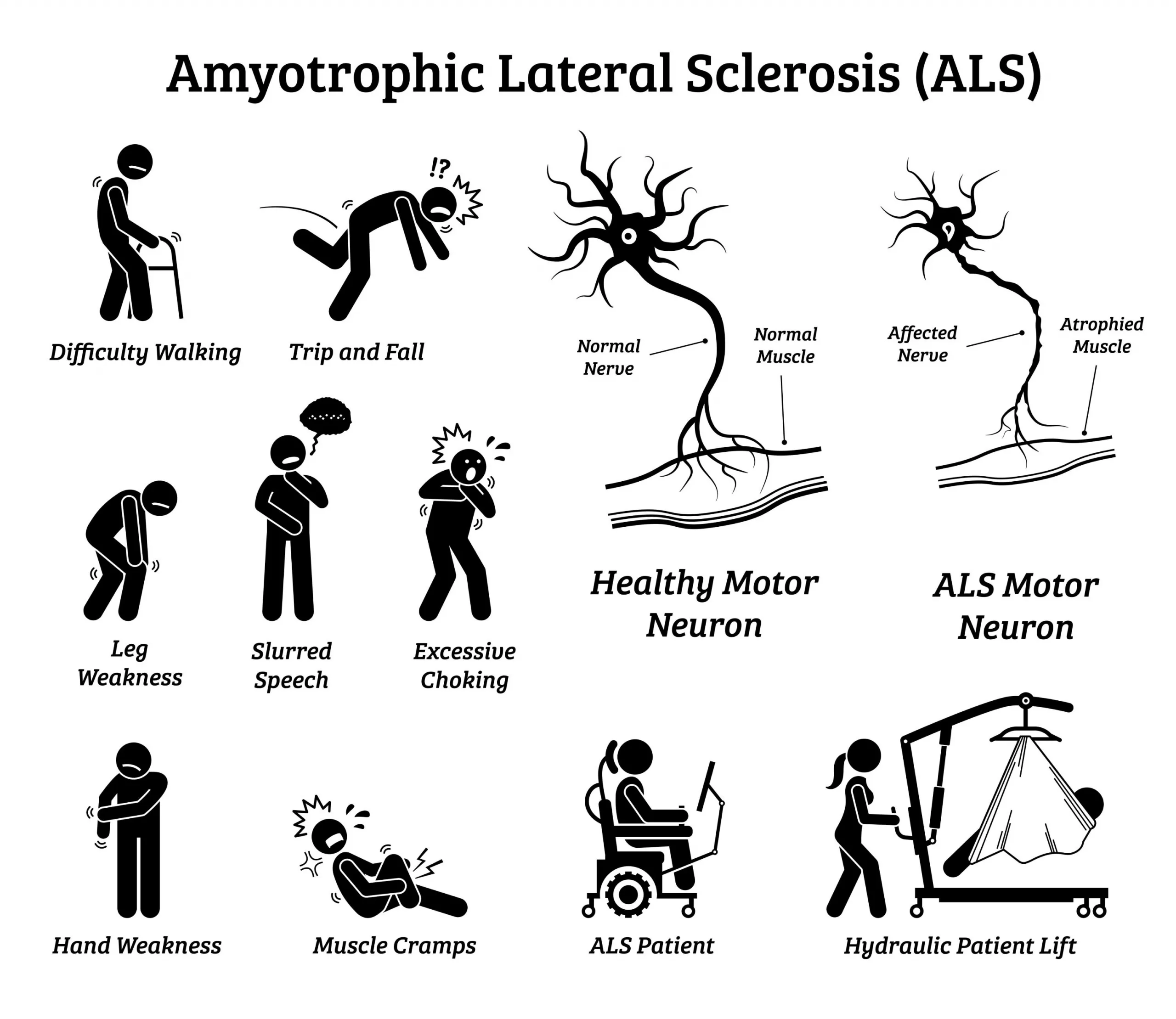 My First ALS Symptoms: The Subtle Signs I Wish I’d Noticed Sooner